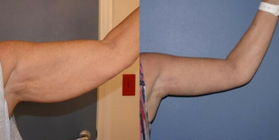 Woman treated with Arm Lift - Woman treated with Arm Lift