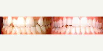 35-44 year old man treated with Braces - Correction of overbite with braces