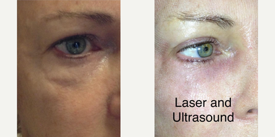 Woman treated with MiXto Laser, Ultherapy - We use a combination treatment of Mixto Fractional CO2 Resurfacing & Ultherapy to tighten the skin. Healing time is about five days & results can last several years!