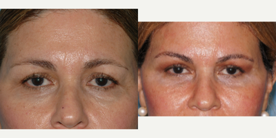 55-64 year old woman treated with Injectable Fillers around the brows and tear troughs - This patient came with the complaint of old appearing eyes. she noted that the shape of her eyes made her look tired, and she was starting to develop bags under her eyes along with dark circles. she was treated with restylane under the eyes, and juvederm ultra along the brows. this accomplished two things - it eliminated the dark circles around the eyes and helped camouflage the developing bags, while also recreating a youthful contour to her upper brow and a more youthful, almond shape appearance to her upper eyes.