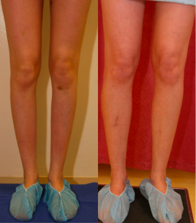 35-44 year old woman treated with Calf Implant - calf augmentation with calf implants in los angeles