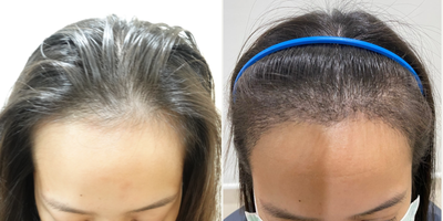 25-34 year old woman treated with DHI Hair Transplant, FUE Hair Transplant, Hair Transplant - A middle-aged Asian woman came in for a FUE hair transplant to lower her frontal hairline using 1,500 grafts. She hasn't been taking any medications for the hair loss.