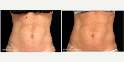35- to 44-year old woman treated with Velashape - A woman in her 40s was concerned about the skin laxity on her abdomen. She did not want any invasive or surgical treatments. VelaShape III was used, and marked tightening of the lax skin was noticed after just 2 treatments. Three to six treatments are recommended for maximum results.