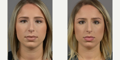 Woman treated with Rhinoplasty, Septoplasty - Septorhinoplasty by Dr. James Marotta
