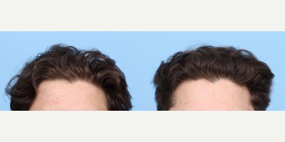 18-24 year old man treated with PRP Injections, PRP for Hair Loss - Prior to PRP hair loss treatment, this 21-year-old patient experienced significant hair thinning, visible scalp, and sparse follicles in certain areas. After three PRP sessions with Dr. Wise, he showed remarkable improvements, including enhanced hair density, thicker strands, reduced scalp visibility, and a fuller look, with noticeable regrowth in the previously thinning areas.