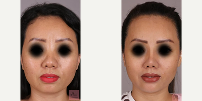 Woman treated with Asian Rhinoplasty - Asian Rhinoplasty is a technically difficult procedure with different techniques used specifically where the dorsum has to be raised and the tip which is a little flat has to be made sharper by using a lot of cartilage.The result is at three months and the patient is more than happy with the sharpness of a tip and overall shape of nose.