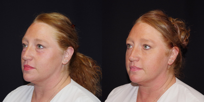35-44 year old woman treated with Restylane Silk - 44 year old female received 2 syringes of Restylane Silk under the eyes; photos depict the patient's results 3 weeks post-treatment.