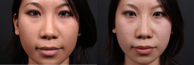 This young lady underwent alar base (nostril) reduction under local anesthesia - 	This 23 year old female desired to have a narrower nostril base. Dr. Repta and the patient discussed her options including her desire to minimize cost and downtime. The patient underwent an alar base reduction under local anesthesia. The patient drove herself to the office and the procedure took about 1 hour. She is shown just 1 week after her procedure with improved width of her nose at the nostril level. Although some swelling is present the results shown depict what can be accomplished quite easily under local anesthesia.