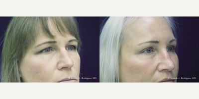 Brow Lift - 45-54 year old woman treated with Brow Lift