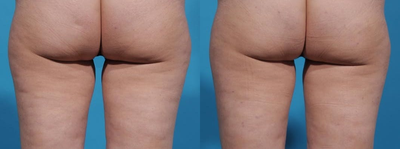 45-54 year old woman treated with Cellfina - This 46-year-old female is 54 and weighs 130lbs. She had cellulite so she underwent Cellfina, a non-invasive, permanent treatment done in the office.