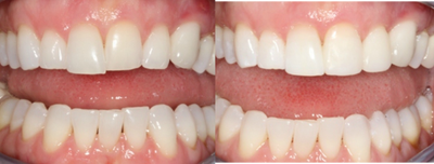 Bonding with Composite to Repair Slanted Smile - 
	As an alternative to veneers, the patient's slanted smile was repaired with tooth-colored composite.
