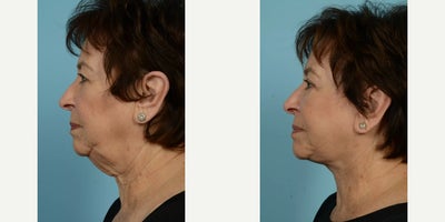 Woman treated with Neck Lift - Woman treated with Neck Lift