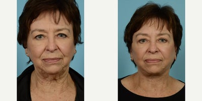 Woman treated with Neck Lift - Woman treated with Neck Lift
