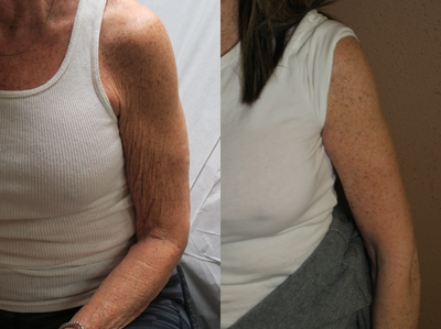 55-64 year old woman treated with Arm Lift - arm lift