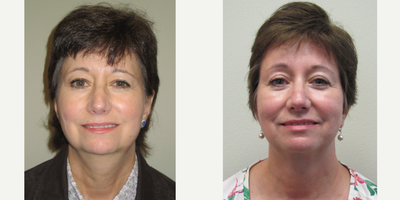 55-64 year old woman treated with Non-Surgical Neck Lift - Patient was treated with Precision TX for the neck, and a brow lift.