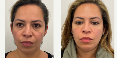 35-44 year old woman treated with Belotero, Voluma - Voluma to cheeks and Belotero to under eye.