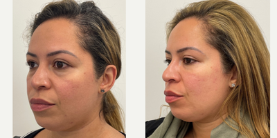 35-44 year old woman treated with Belotero, Voluma - Voluma to cheeks and Belotero to under eye.