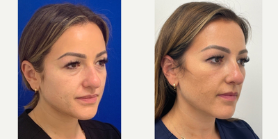 25-34 year old woman treated with Belotero - Belotero to fill in under eye hollows.