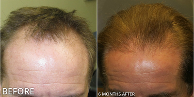 Man treated with Hair Transplant, ARTAS Robotic Hair Transplant - Man treated with Hair Transplant, ARTAS Robotic Hair Transplant