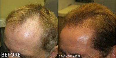 Man treated with Hair Transplant, ARTAS Robotic Hair Transplant - Man treated with Hair Transplant, ARTAS Robotic Hair Transplant