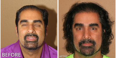 Man treated with Hair Transplant, ARTAS Robotic Hair Transplant - Man treated with Hair Transplant, ARTAS Robotic Hair Transplant