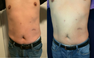 55-64 year old man treated with Emtone - 4 sessions of Emsculpt Neo and Emtone, and already seeing amazing results at 4 weeks!