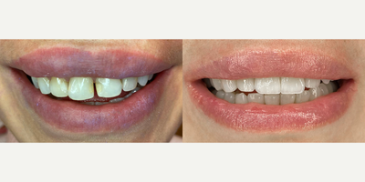 35-44 year old woman treated with Smile Makeover, Teeth Whitening, Lumineers - We treated smile makeover, office type bleaching and emax lamina for our patient.