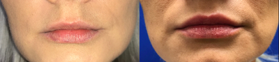 35-44 year old woman treated with Restylane Silk - Restylane Silk injections in this young woman's upper and lower lips.
