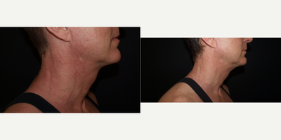 45-54 year old man treated with Dermapen - Microneedling with PRP used to treat ruddiness and textural issues on the neck.