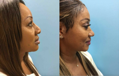 45-54 year old woman treated with Revision Rhinoplasty - 45-54 year old woman treated with African American Revision Rhinoplasty