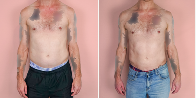 45-54 year old man treated with Vaser Liposuction - This patient wanted to remove excess fat from his abdomen and requested liposuction to improve his shape.