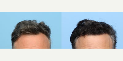 55-64 year old man treated with FUE Hair Transplant, Hair Transplant, Hair Loss Treatment, PRP for Hair Loss - Dr. Wise performed an FUE hair transplant on this patient, transplanting 2,050 grafts to zone 1, in order to bring his receding hairline forward. Additionally, one session of PRP therapy was done to strengthen the follicles and expedite the healing process.