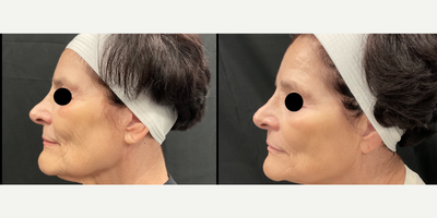 65-74 year old woman treated with Potenza - Only 1 session of Potenza post 4 weeks