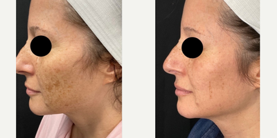 45-54 year old woman treated with ThreeForMe - Icon: Three For Me results after 4 weeks.