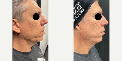 45-54 year old man treated with Potenza - 3 sessions of Potenza RF Microneedling