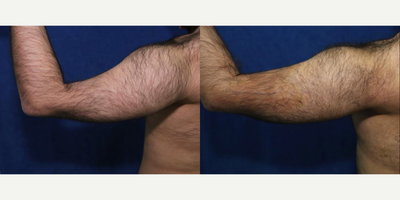 Fat Transfer to Biceps - Fat Transfer to Biceps