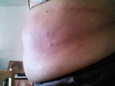 My abdomen is still big, soft & hanging. No more hard lumps or tingling