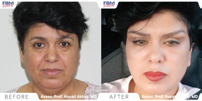 45-54 year old woman treated with Deep Plane Facelift, Double Eyelid Surgery, Facial Fat Transfer - This patient wanted to have a face that looks more refreshed and youthful. with a Deep plane facelift, Blepharoplasty, and facial; fat transfer, she had her transformation process to be mor rejuvenated .