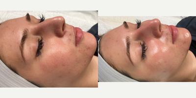 25-34 year old woman treated with DiamondGlow, Skin Rejuvenation, Skin Lightening - We did one DiamondGlow treatment using the pore clarifying serum.