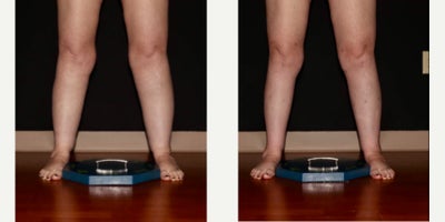 45-54 year old woman treated with Lipedema Surgery to her bilateral calves and ankles - 8 weeks post op for bilateral calves and ankles