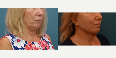 45-54 year old woman treated with Neck Lift - Patient under a face and neck lift. Her main concern was loss of definition of her jaw line and the excess skin/fat overhanging from her neck. Note incisions are imperceptible 6 weeks after surgery. She has a nice soft redefined jaw line and smooth neck contour.
