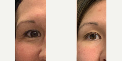 35-44 year old woman treated with ThermiSmooth Face - Patient received thermismooth around the eye. 1 treatment weekly for 4 weeks.