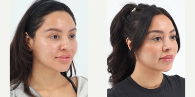 25-34 year old woman treated with Rhinoplasty - 27 year old 1 month after primary Rhinoplasty by Dr. Robert Chouake.