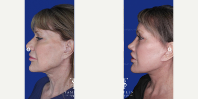 Woman treated with Brow Lift, Deep Plane Facelift, Lip Lift, Rhinoplasty - This lovely patient had a previous facelift but was bothered by persistent jowls and neckbands.She was also unhappy with the appearance of her nose and the scarring from her previous facelift.She now absolutely loves her new look which was achieved through 1 single transformative procedure that included my extended deep plane facelift, lateral brow lift, lip lift, and open rhinoplasty.Looking refreshed, elegant, and natural. Loving these results!