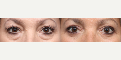 55-64 year old woman treated with Double Eyelid Surgery, Eyelid Surgery - This 56-year-old patient was unhappy with her heavy upper eyelids, lower eyelid bags and her deep tear troughs and under eye dark circles. She underwent upper and lower eyelid surgery to achieve a refreshed and youthful appearance.