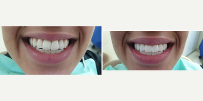 25-34 year old woman treated with Zoom Whitening - Patient wanted a brighter smile instantly.