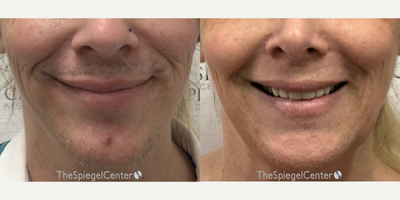 45-54 year old transgender woman treated with Jaw Reduction - Mandible and chin contouring