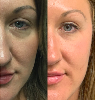 35-44 year old woman treated with ThermiSmooth Face - Patient had thermismooth for under eye bags and crows feet. Treatment included 1 weekly treatment for 4 weeks.