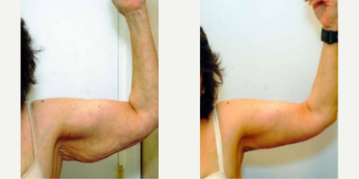 Woman treated with Arm Lift - Woman treated with Arm Lift