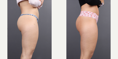 Woman treated with Sculptra BBL - Non-Surgical BBL